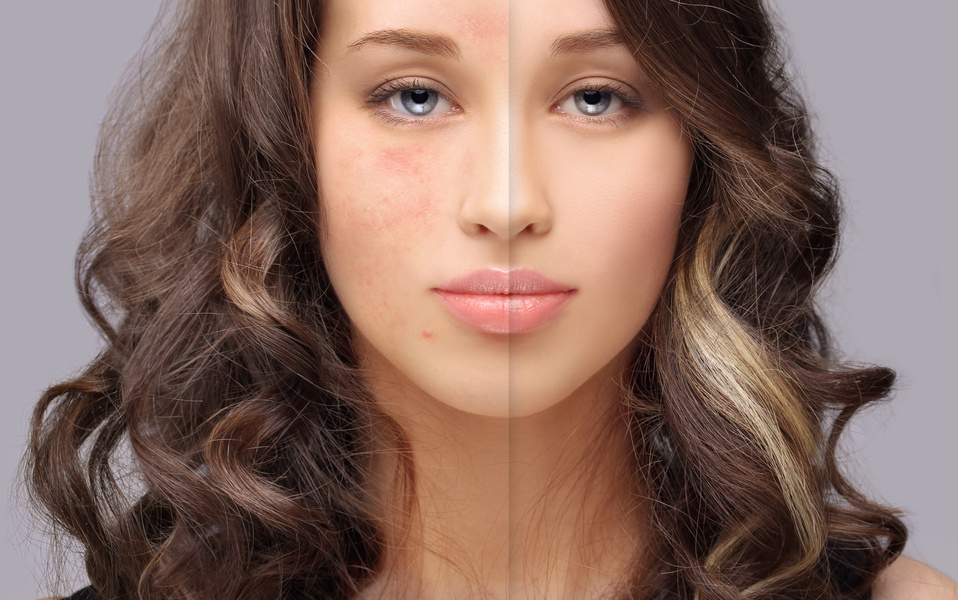 Post-Acne Marks /Treating Acne Scars.Acne Scar Removal