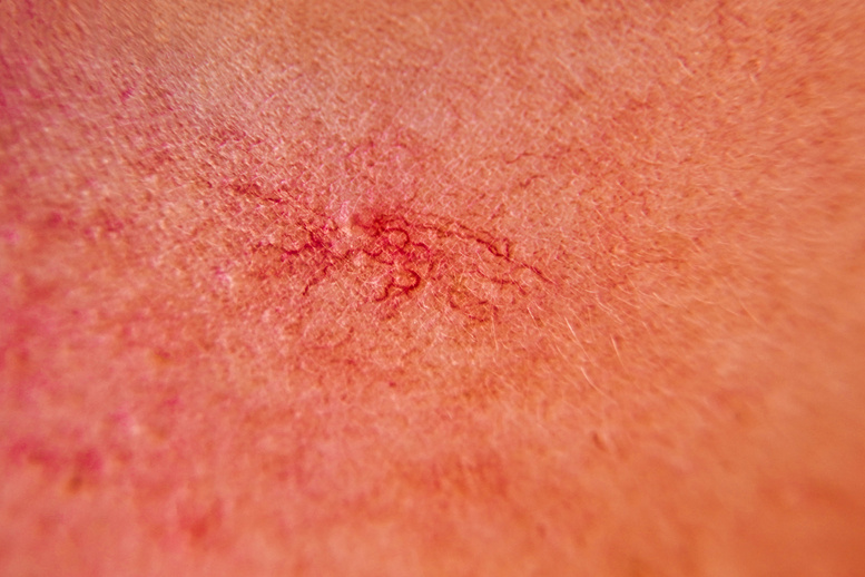 Close-up on the skin of the girl's face are visible couperose, red and dilated capillaries, spider veins, vascular problems